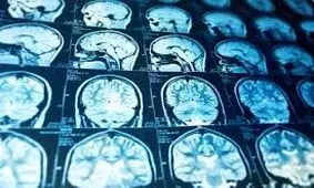 هشدار پزشکان آمریکایی نسبت به شیوع بیماری شبه فلج‌اطفال در کودکان