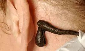 عجیب‌ترین روش‌های درمانی در جهان / عکس