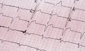 استفاده از روشی نوین در کنترل آریتمی‌های بطنی در بیمارستان امام اهواز