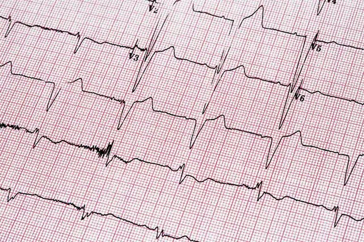 استفاده از روشی نوین در کنترل آریتمی‌های بطنی در بیمارستان امام اهواز