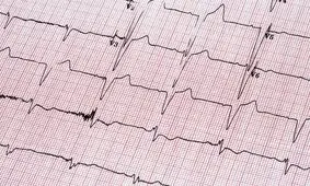 استفاده از روشی نوین در کنترل آریتمی‌های بطنی در بیمارستان امام اهواز