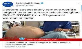 بیرون آوردن بزرگترین تومور تخمدان در جهان