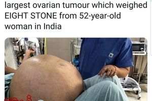بیرون آوردن بزرگترین تومور تخمدان در جهان
