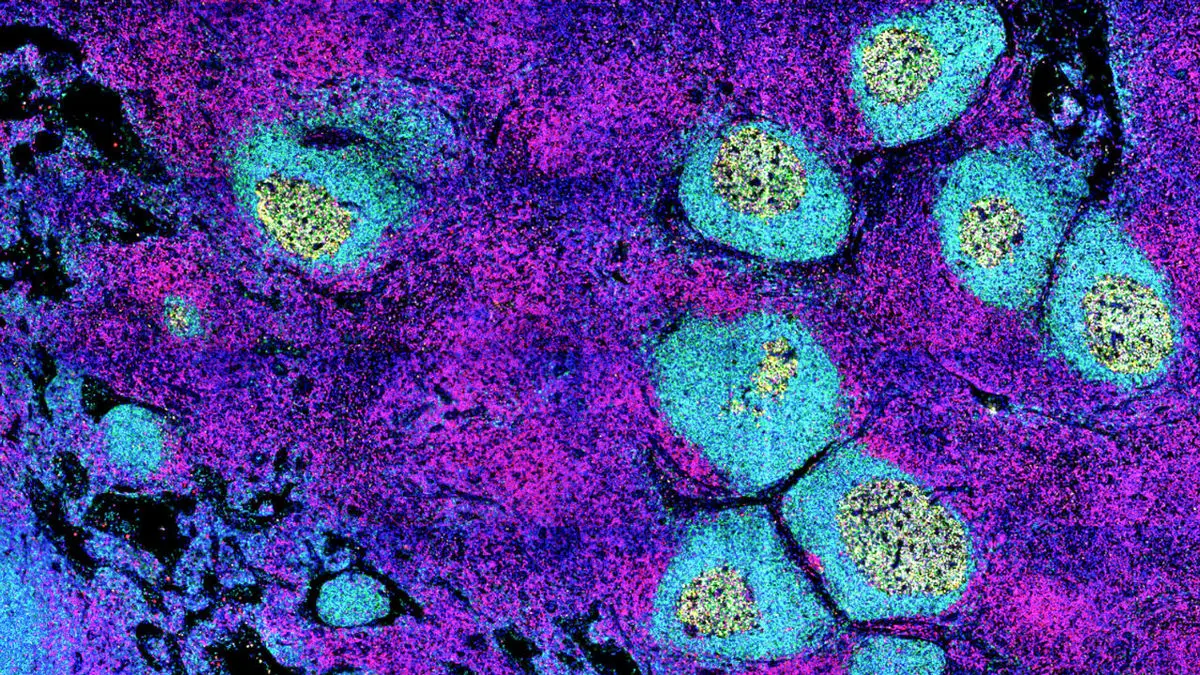 دلیل ابتلای مجدد افراد به کرونا کشف شد
