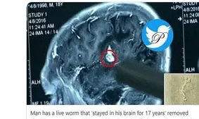 زندگی با کرم 12.7 سانتی‌متری در مغز به مدت 17 سال