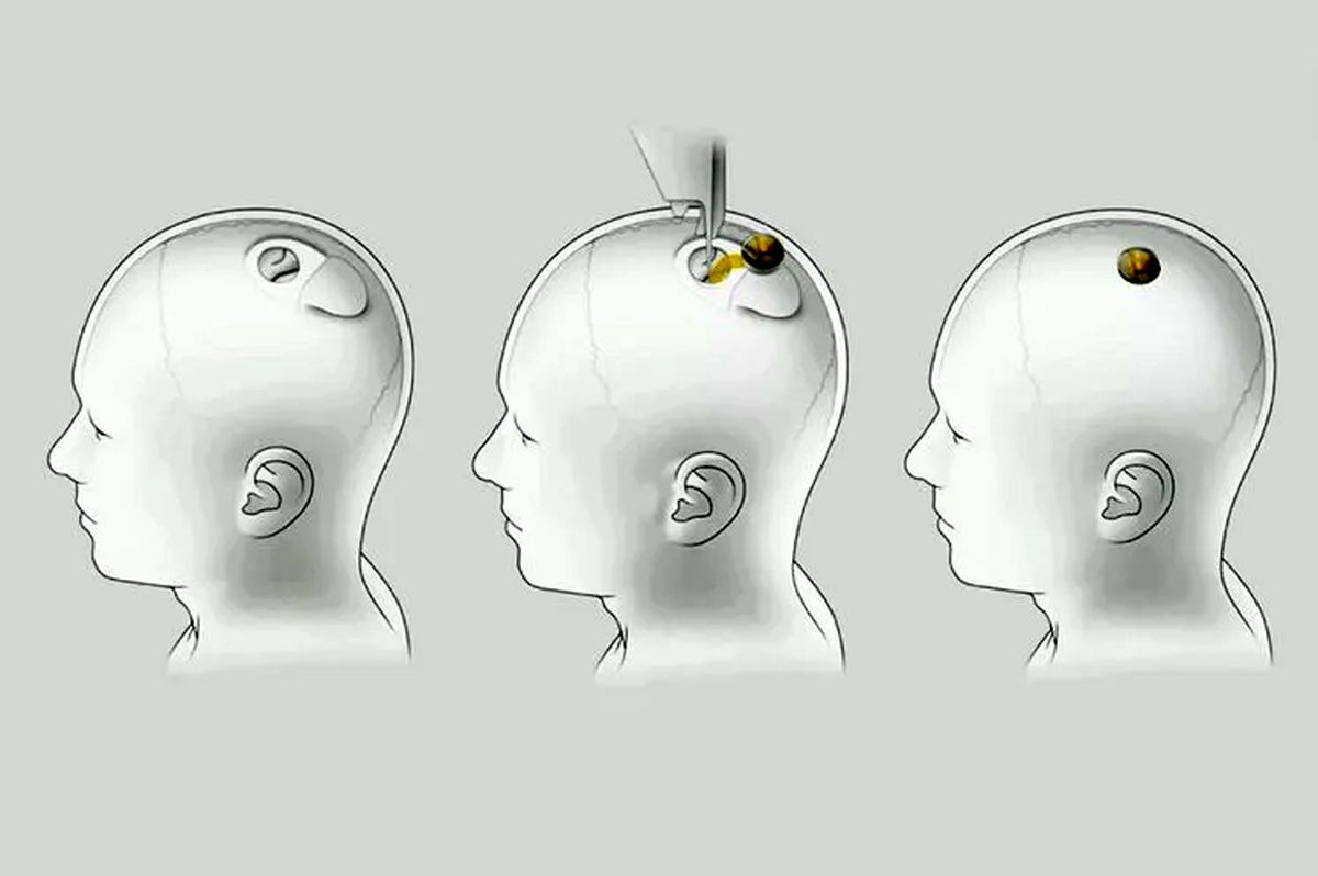 ایلان ماسک رابط مغز رایانه نورالینک را در خوک زنده رونمایی کرد