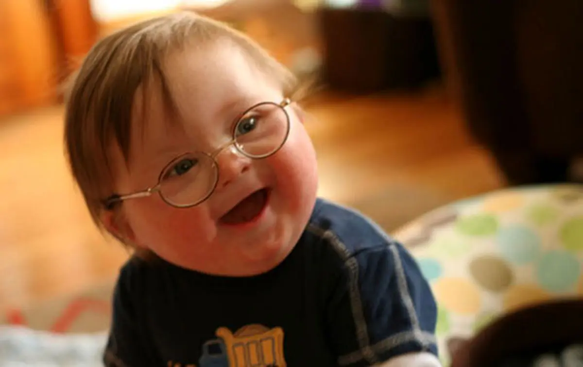 خانم‌های باردار، اهمیت غربالگری سندروم داون را جدی بگیرید