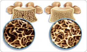 نکاتی برای سلامت استخوان‌ها