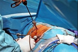 جراحی پیوند کلیه از هفته آینده در همدان دوباره آغاز می‌شود