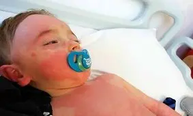 سندرم کودکی مرتبط با کرونا در سیستم ایمنی تغییر ایجاد می‌کند