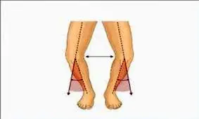 صافی کف پا و پاهای پرانتزی، علت چیست؟