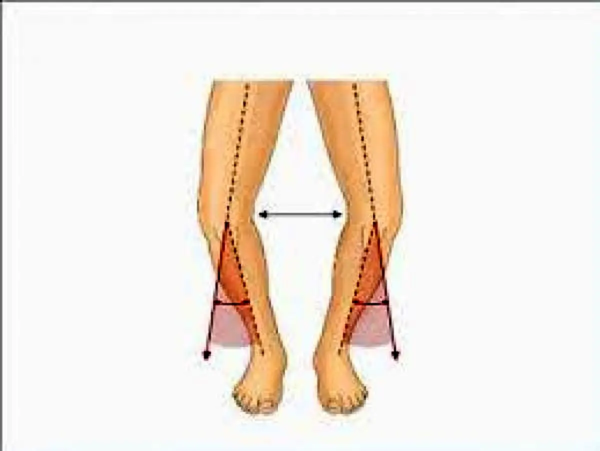 صافی کف پا و پاهای پرانتزی، علت چیست؟