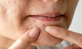 مصرف کدام مواد غذایی برای جلوگیری از جوش زدن مفید است؟