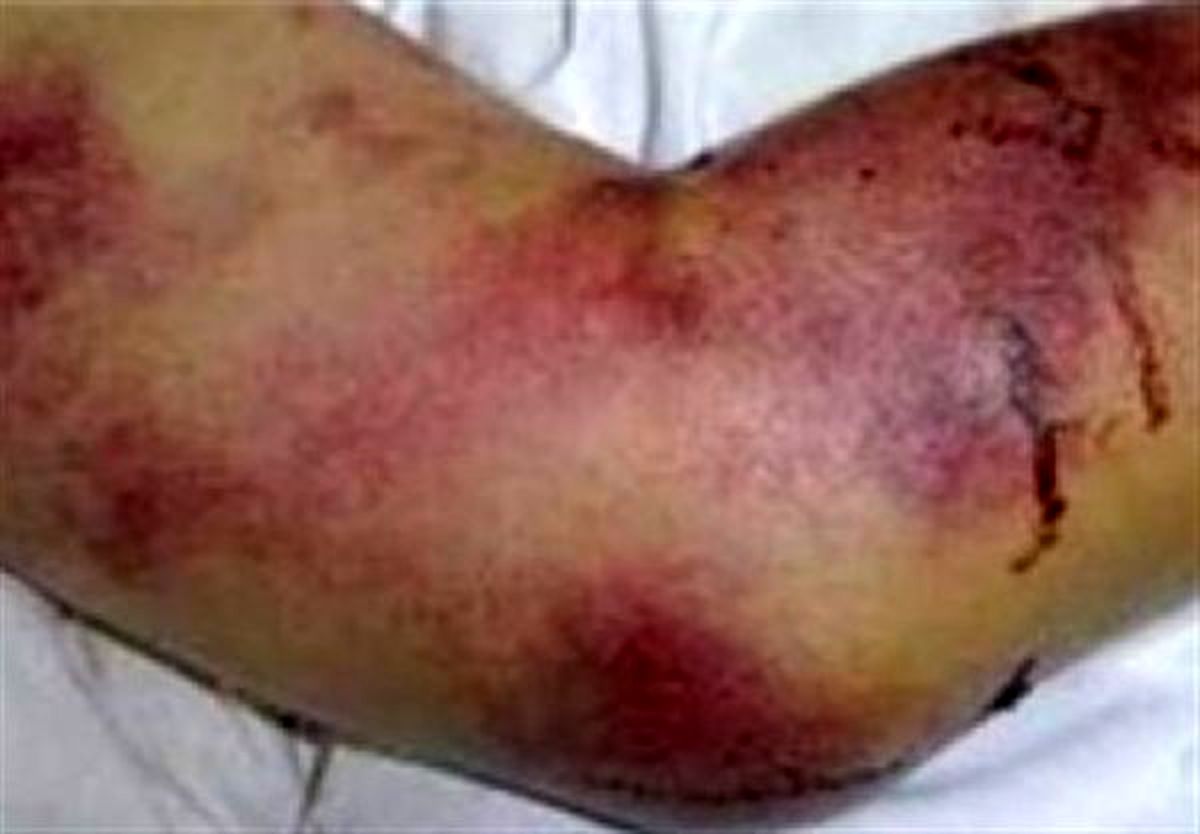 ماجرای دفن یک بیمار در اصفهان/وضعیت سفید برای تب کریمه کنگو