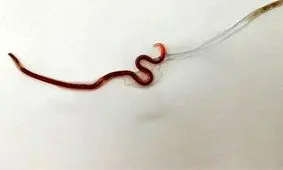 خارج کردن کرم زنده ۴ سانتی از گلوی یک زن جوان