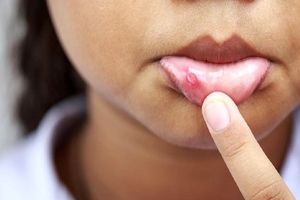 ترفند‌های خانگی برای درمان آفت دهان