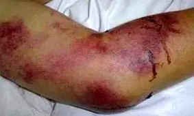 تایید فوت یک نفر بر اثر تب کریمه کنگو در هرمزگان