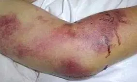 تایید فوت یک نفر بر اثر تب کریمه کنگو در هرمزگان