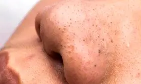 ۷ ترفند خانگی برای از بین بردن جوش‌های سرسیاه