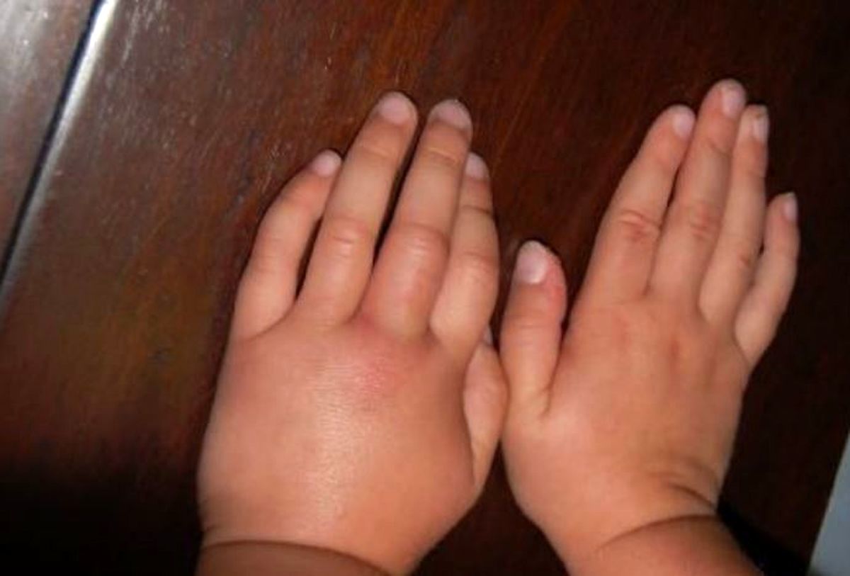 چرا دستها ورم میکنند؟