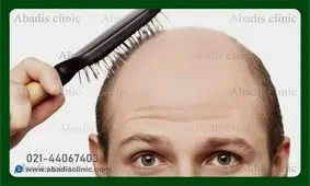 چقدر از هزینه های کاشت مو مطلع هستید؟