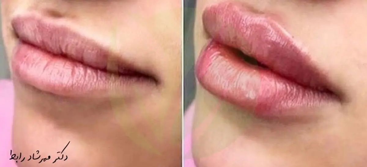 همه چیز درباره تزریق ژل لب