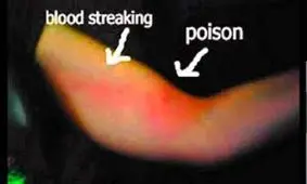 قطع‌کردن ناباورانه دست‌و‌پای زن ۵۷ ساله تنها برای یک خراش با کاغذ!