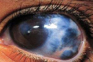 آب سیاه چشم؛ از علائم تا روش‌های درمان