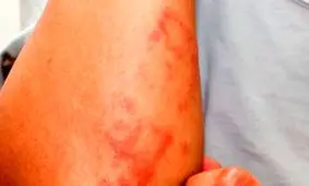 تاثیر خطرناک کرونا بر پوست / همه علائم کرونا روی نوجوانان و جوانان !