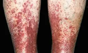 دلخراش‌ترین علائم پوستی که نشان دهنده ابتلا به کروناست