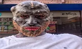 عمل جراحی عجیب از جوان ۳۲ ساله موجودی شبیه هیولای فضایی ساخت/ عکس