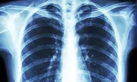 ویروس کرونا ریه مبتلایان را سوراخ می‌کند!