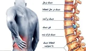 درمان کمر درد