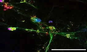 ارتباط تشکیل شبکه‌های DNA در ریه با شدت ابتلا به کووید-۱۹