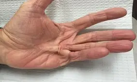 از بیماری کف دست چه می‌دانید؟