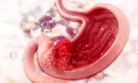 سرطان معده، نخستین سرطان شایع در میان مردان خراسان شمالی