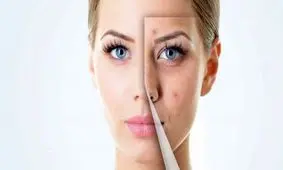 با این مواد طبیعی از شر جای جوش خلاص شوید