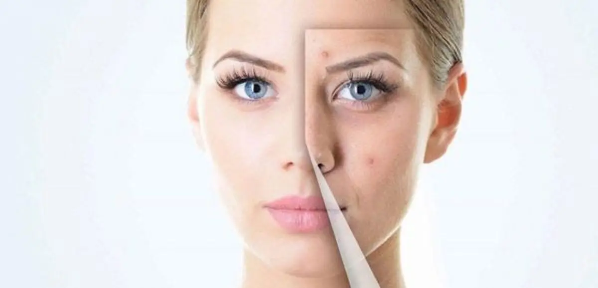 با این مواد طبیعی از شر جای جوش خلاص شوید