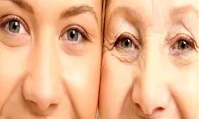 درمان چین و چروک دور چشم به روش نوین