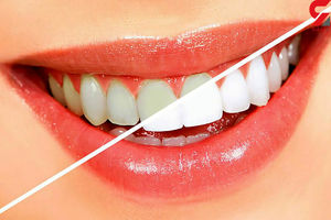 5 راه حل برای فرار از دندان های زرد