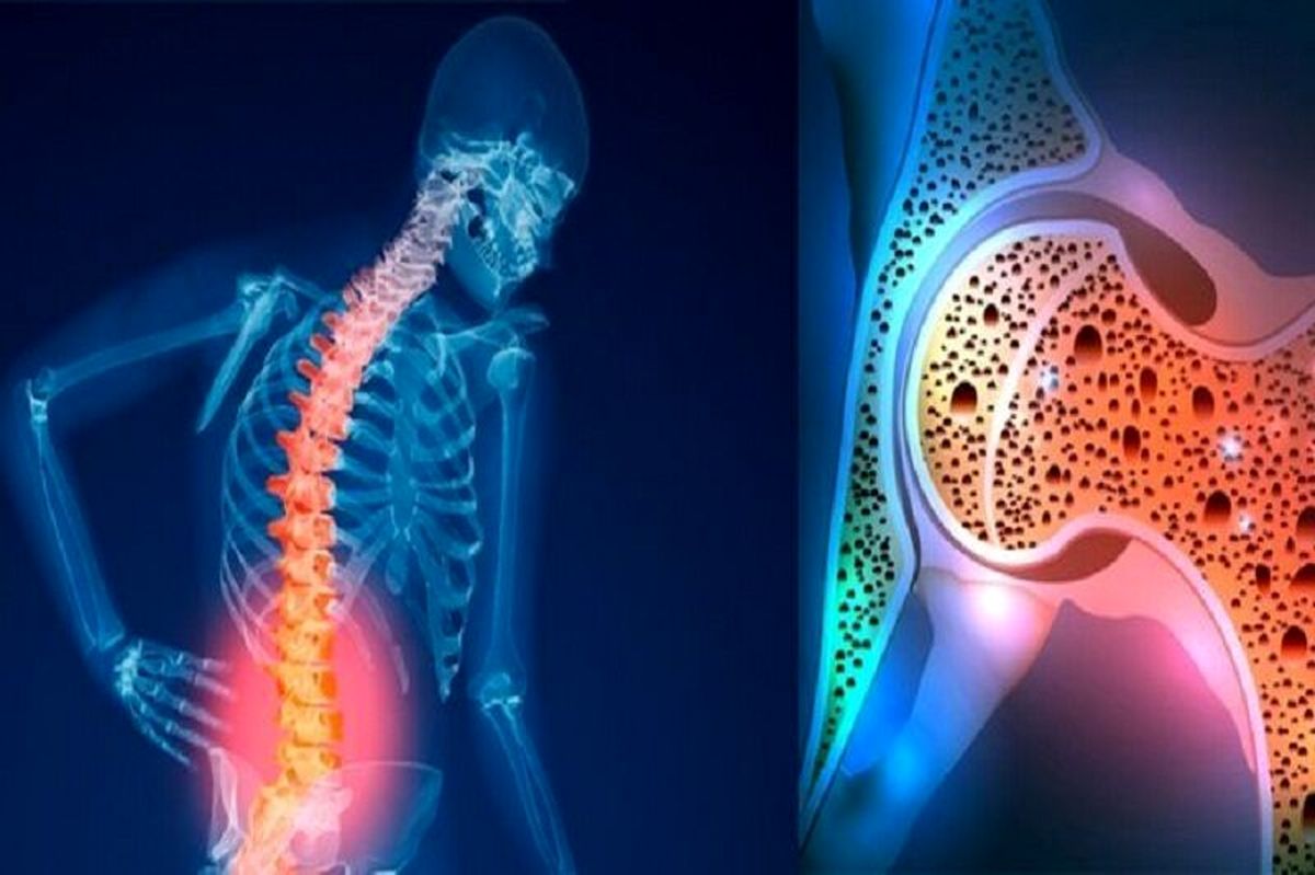 میزان بروز پوکی استخوان بیشتر از سایر بیماری‌های غیرواگیر است