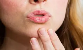 5 درمان خانگی برای بهبود لب‌های ترک خورده