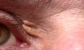 حالتی هشداردهنده روی پوست که از کلسترول بالا حکایت دارد