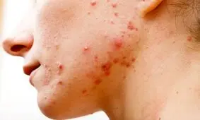بهترین درمان های خانگی برای از بین بردن سریع جای جوش روی صورت