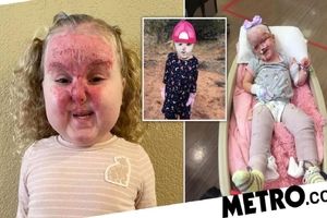 وضعیت دردناک دختر ۴ ساله بعد نجات از انفجاری مهیب