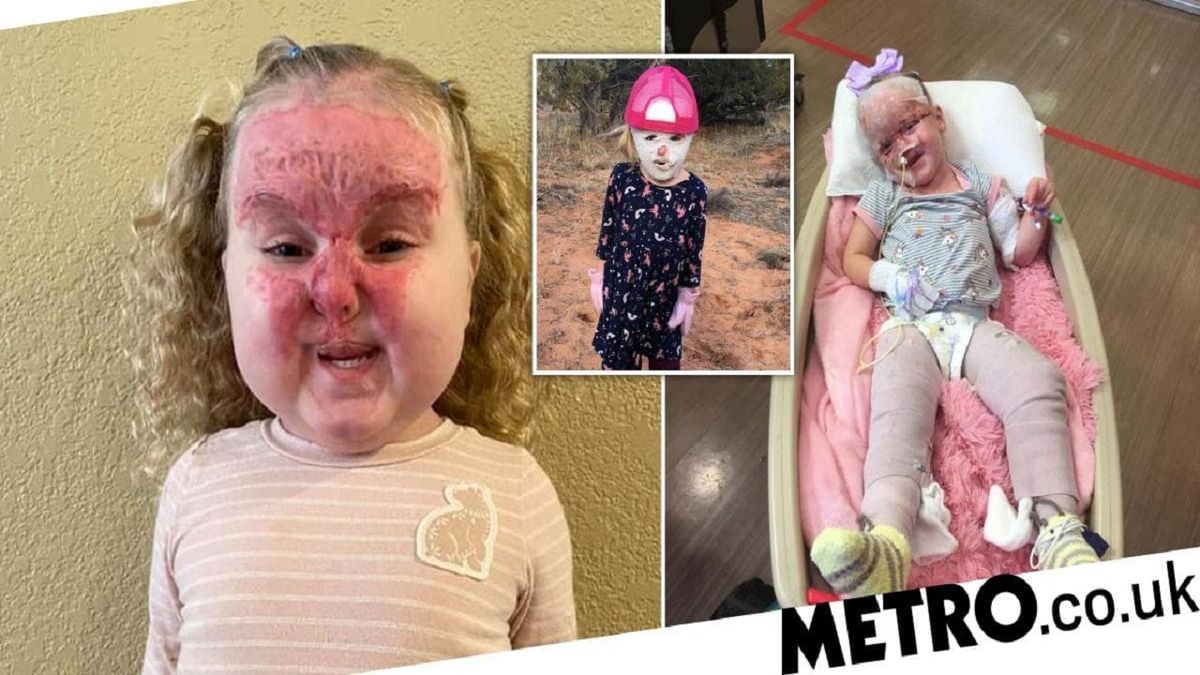 وضعیت دردناک دختر ۴ ساله بعد نجات از انفجاری مهیب