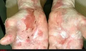 کمبود شدید داروهای بیماران نادر/ وجود ۴۰۰ فردِ ۶۰ سانتی در کشور/ افزایش شیوع بیماری سلیاک/ بیماری "عماد" دیر تشخیص داده شد