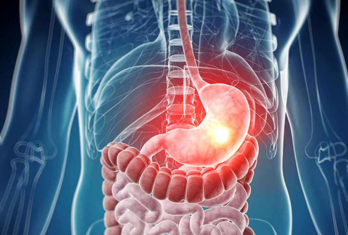 چگونه متوجه شویم مشکوک به سرطان روده هستیم؟