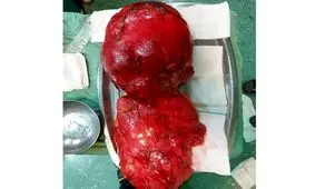 خارج کردن دو توده‌ به وزن ۱۲ کیلو از شکم زن نهاوندی