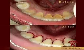 آیا جرم گیری دندان کودکان عوارض دارد ؟